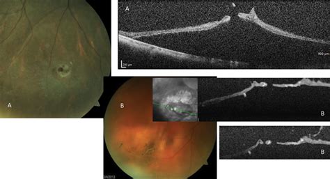 A Field Guide to Retinal Holes and Tears