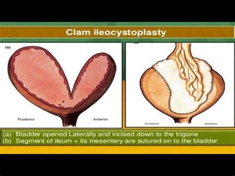 Ileocystoplasty Mitrofanoff for PUV CKD Valve Bladder @Pediatric ...