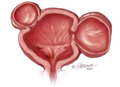 What is a Bladder Diverticulum? - Urology Care Foundation