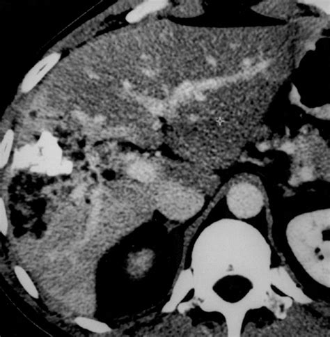 Echinococcus multilocularis Revisited | AJR