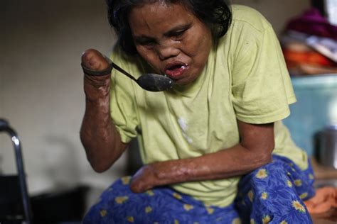 Sad Story Of A Teenager Living With Leprosy │Stigma Associated With The Disease