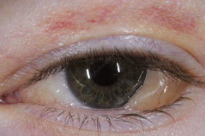 Swelling (chemosis) of the conjunctiva - Stock Image - C011/7531 - Science Photo Library