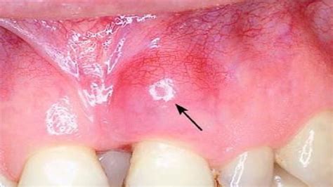 Gingival Abscess Prevention And Treatment