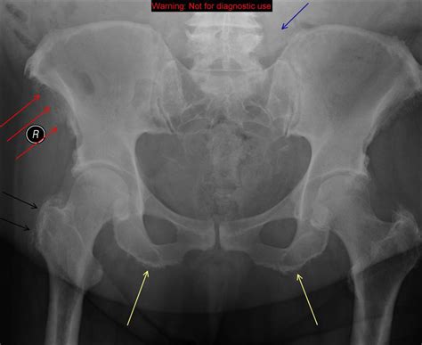 File:DISH in pelvis.jpg - Physiopedia, universal access to physiotherapy knowledge.