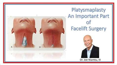 Platysmaplasty: an important part of face and neck lift surgery