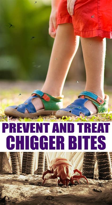 How to Prevent and Treat Chigger Bites | Chigger bites, Holistic recipes, Diy natural products