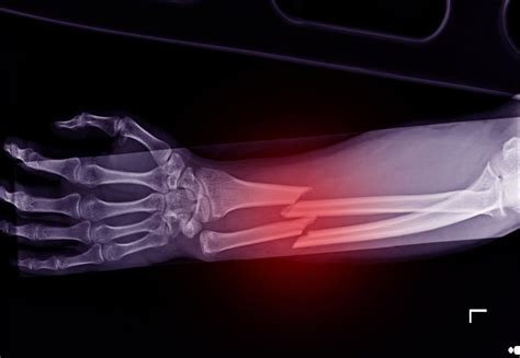 Broken Bones – Symptoms, Treatment, and Complications - Philbrook Law ...