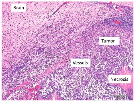 Hematoxylin and eosin staining. Typical growth characteristics of ...