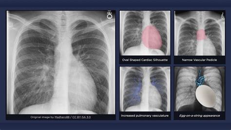 Transposition Of The Great Arteries X Ray