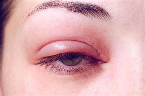 What Could a Swollen Eyelid Mean: 10 Possible Causes