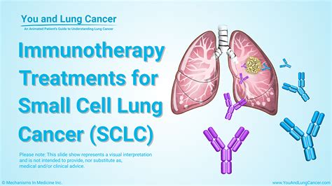 Slide Show - Immunotherapy Treatments for Small Cell Lung Cancer (SCLC)