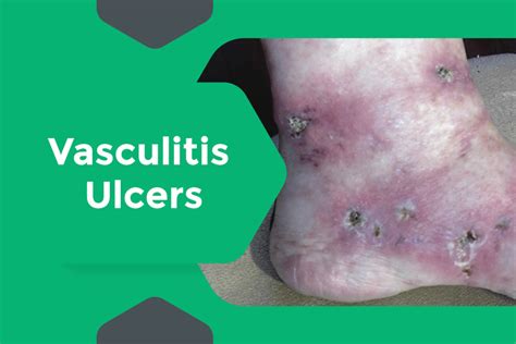 Vasculitis Ulcers