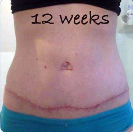 Pictures of swelling after tummy tuck » Tummy Tuck: Prices, Photos ...