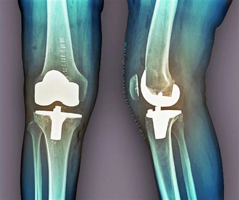 Total Knee Replacement, X-rays by Zephyr