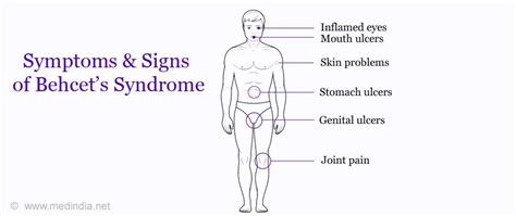 Behcet’s Disease - Its Symptoms, Causes And Types