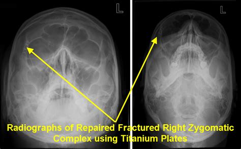 Fractured Eye Socket X Ray