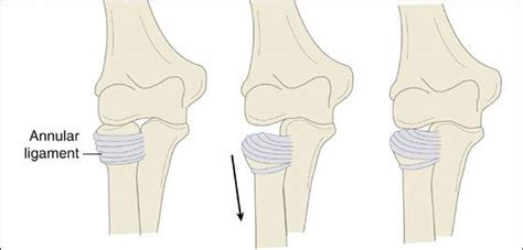 Pictures Of Anular Ligament