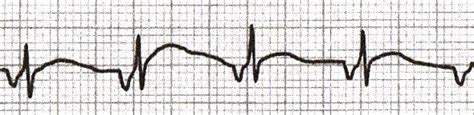 P wave • LITFL • ECG Library Basics