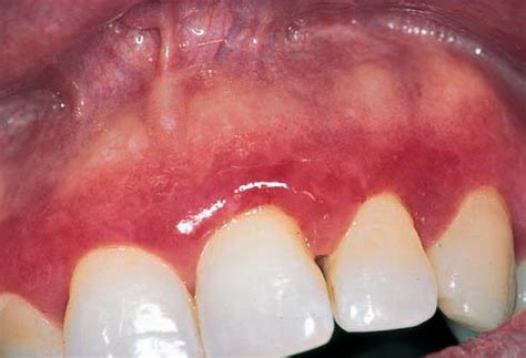 Red Lesions of the Oral Mucosa-Differential Diagnosis, Clinical Features and Treatment ...