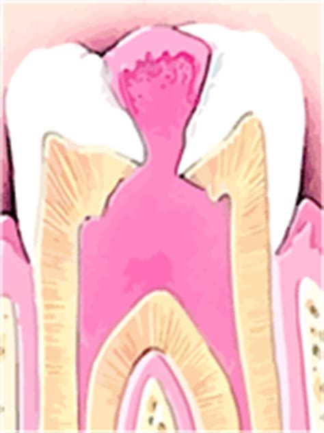 Causes of Pulp Polyps and Dental Pulp Polyp treatment - Remedy Land