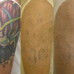 Tattoo Removal | Washington, DC | Center for Laser Surgery