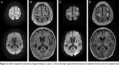 Figure 2 from Two Cases of 'Man-in-the-Barrel' Syndrome Caused by ...