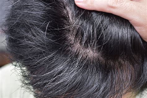 Understanding The Different Types Of Scalp Conditions