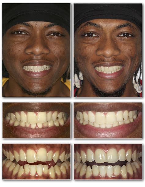 Invisalign Before and After — Invisalign Studio