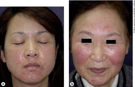 Tacrolimus-Induced Rosacea-Like Dermatitis: A Clinical Analysis of 16 ...