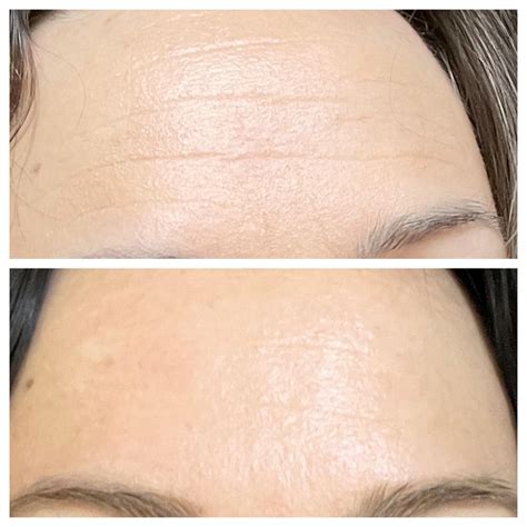 Retinol Before And After Wrinkles | informacionpublica.svet.gob.gt