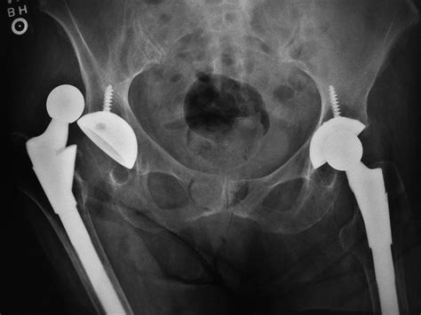 Joint Arthroplasty: a gallery