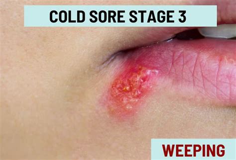 Cold Sore Stages, with Pictures