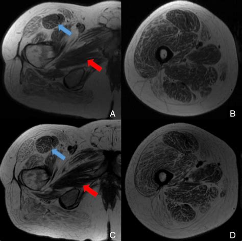 T1-weighted images on MRI of the thigh muscles. Upper images show... | Download Scientific Diagram