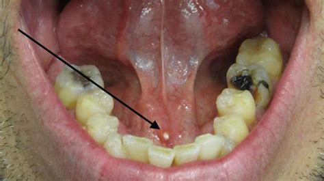 Salivary stones: Symptoms, causes, and how to get rid of them