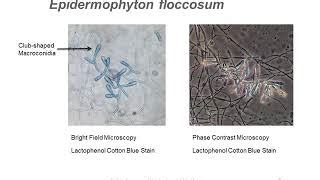 Tinea Pedis Microscope