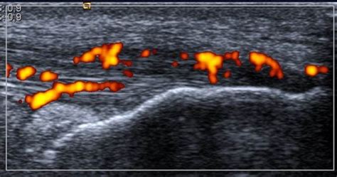 Achilles enthesitis defined by ultrasound is not associated with ...