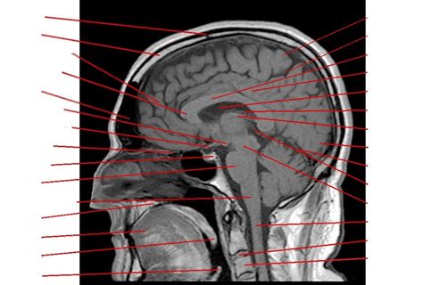 Midline MRI Scan of The Brain Labelled Diagram | Quizlet