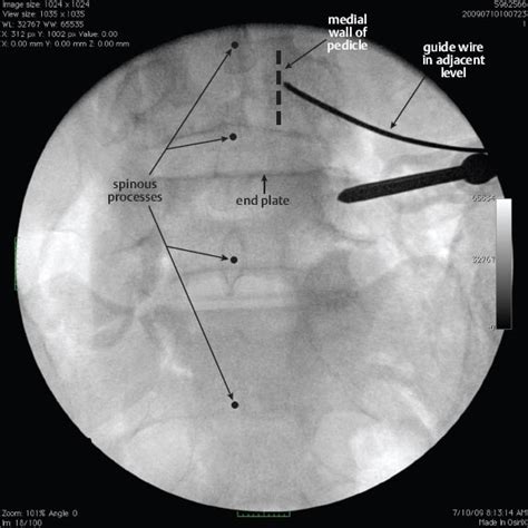 Percutaneous Pedicle Screw Placement | Neupsy Key