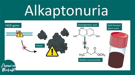 Alkaptonuria | Alkaptonuria, Causes, Signs and Symptoms, Diagnosis ...