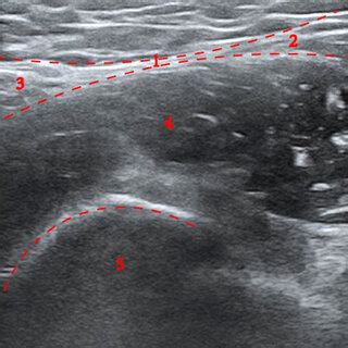 Fascia iliaca compartment block: bow-tie in the iliac fascia region on... | Download Scientific ...