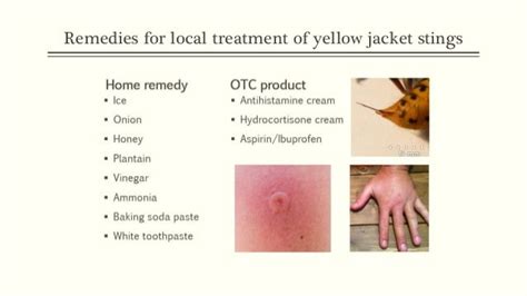 Treatment For Yellow Jacket Sting | Parents Republic