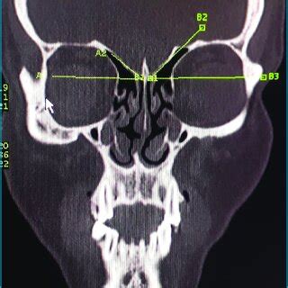 Take-off angle of the ethmoid roof from horizontal plane of CT scan ...