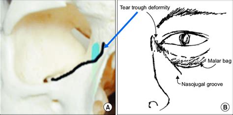 The relationship between (A) Tear trough and underlying orbital bone... | Download Scientific ...