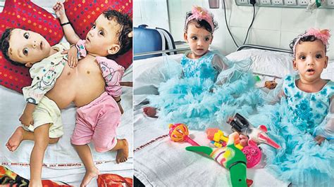 1-year-old conjoined twins separated after 12-hr surgery at AIIMS | Latest News Delhi ...