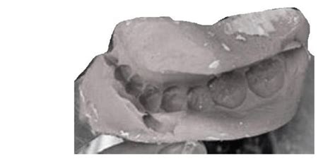 A dental impression made using alginate impression material. | Download ...