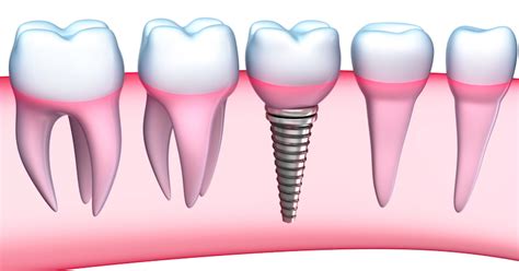 Dental Implant Surgery Recovery - Dental News Network