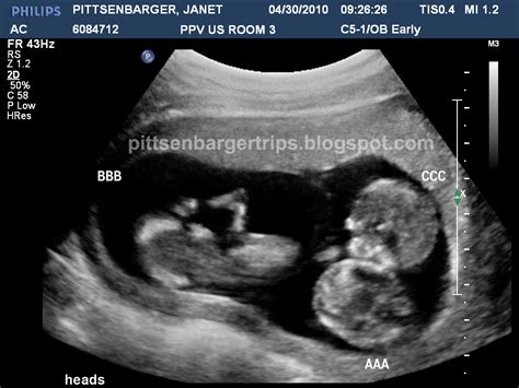 PITTS TRIP'S: the Pittsenbarger identical triplets saga: 12 week Ultrasound