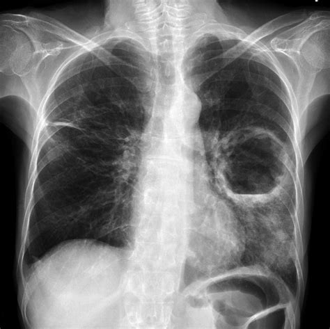 MEC&F Expert Engineers : Rapid Progression of Black Lung Disease ...