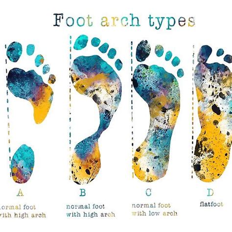 ‘Human types of footprints-foot arch types’ by Rosaliartbook in 2022 | Foot arches, Flat feet ...