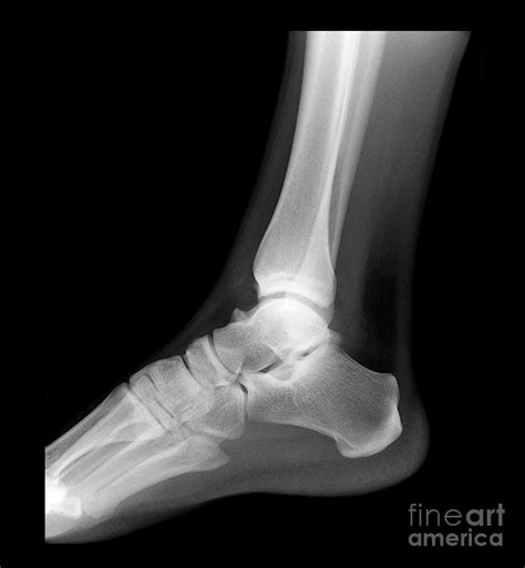 Ankle X-ray, Normal Photograph by Living Art Enterprises